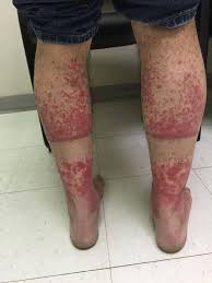 Triệu chứng của bệnh vi&ecirc;m mao mạch dị ứng c&ograve;n gọi l&agrave; hội chứng vi&ecirc;m mạch  Schonlein - Henoch. Vi&ecirc;m mao mạch dị ứng c&ograve;n được biết đến với nhiều t&ecirc;n gọi