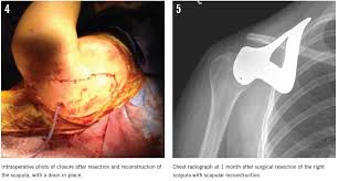 Image result for Ewing Sarcoma