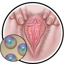 The symptoms of herpes in females are very similar to those in males. Herpes Sex U