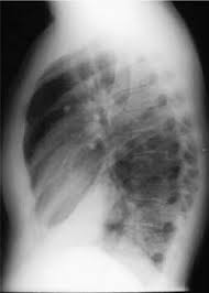 The neutrophilic infiltrate is chiefly around the centre of the bronchi. X Ray Atlas Chest X Ray Glowm