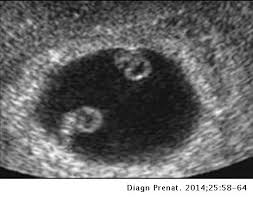 You will find twin ultrasounds, twin pregnancy signs and symptoms, as well as. Diagnosis Of Chorionicity The Role Of Ultrasound Diagnostico Prenatal