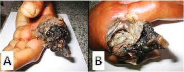Myasis—by this term (spelled also myiasis, and myiosis), is meant parasitism by dipterous larv. A Rare Case Of Digital Myiasis Sciencedirect