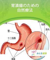 胃潰瘍のための自然療法 みんな健康 自然療法 胃潰瘍 健康