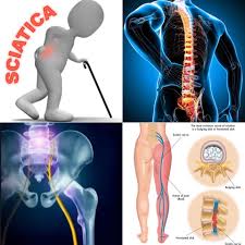 La sciatica (o sciatalgia) è una patologia molto diffusa a cui sono soggetti indifferentemente sia le donne che gli uomini. Sciatalgia Enzo Pierro Massage Therapy