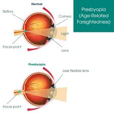 Image result for Presbyopia