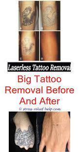 The laser breaks the pigment. Can Tattoos Be Removed How To Remove Kid Tattoos At Home How To Become A Tattoo Removal Specialist Tattoo Goo B Tattoos Kinder Tattooentfernung Erstes Tattoo