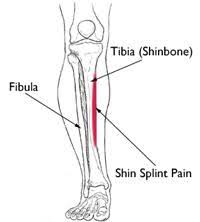 Shin splints not a specific injury, but term used to describe pain on the lower, inside of the shin. Are Your Shins Painful When You Run Or Hop It Sounds Like Shin Splints The Physio Depot
