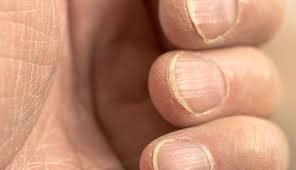Also called longitudinal melanonychia, this condition refers to the presence of a dark pigmented stripe along the length of the nail bed. What Are Your Nails Saying About Your Health