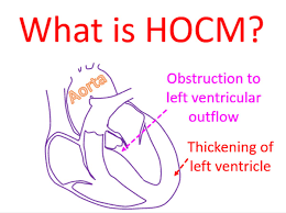 Image result for Left Ventricular Outflow Obstruction