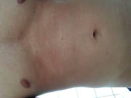 The exact cause that is responsible for causing lesions is not known. Weisse Flecken Nach Sonnen Kann Das Ein Pilz Sein Haut Hautpilz