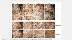 To pair with its hair growth supplements, nutrafol has released its first topical product, the nutrafol has announced the release of its first topical product: A New Strategy Increases Hair Growth Combination Of Topical Adenosine And Caffeine Hair Tonic Semantic Scholar