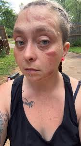 meaning of post concussion sydrom