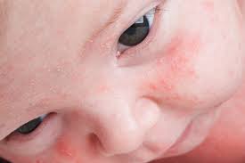 Image result for red rash face
