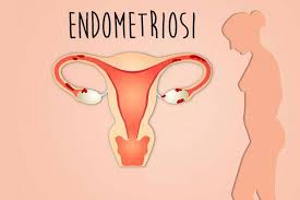Quali sono le cause dell'endometriosi? L Endometriosi Nubra Medica Poliambulatorio Carpi