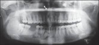 The correct answer is a. Concomitant Occurrence Of Infected Cemento Osseous Dysplasia And Radicular Cyst In Young Indian Female An Unusual Case Report
