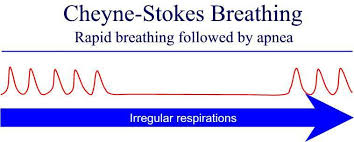 Image result for Cheyne-Stokes Respiration