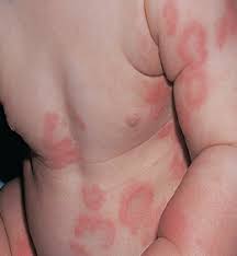 Image result for dermatitis contacta allergica