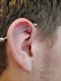 Keloid Scar From Ear Piercing Healed By Nourisil Md Scar Treatment -  Nourisil™ Md