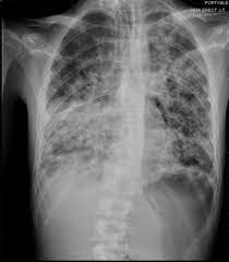 Chest X Ray Showing Diffuse Bilateral Airspace Disease With Right Sided Download Scientific Diagram