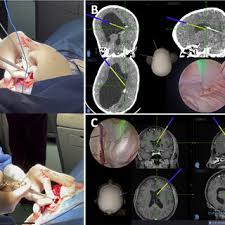 Intraventricular time navigation. Assembly description. (A) The LOTTA...