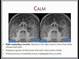 Image result for Sinus X Ray