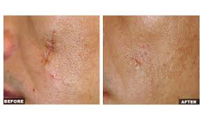 Because one type of acne scar wouldn't be enough to deal with, the powers that be created two different types of acne scars: Fraxel Treatment Clinic In London