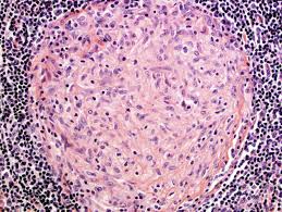 Granulome Definition Und Synonyme Von Granulome Im Worterbuch Franzosisch