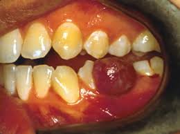 Image result for granuloma gum disease