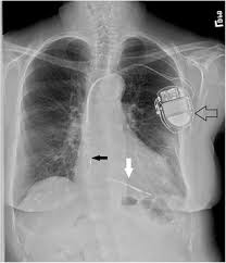 Classification follows pacemaker code developed by the north american society of pacing and electrophysiology (naspe) and the british pacing and electrophysiology group (bpeg). Cardiac Implantable Electric Devices Indications And Complications Springerlink