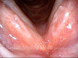 Image result for Acute Laryngitis