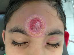 Resultado de imagen para leishmaniasis