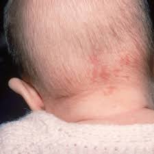 This is a condition marked by a low number of red blood other causes, red spots on the skin can occur due to allergic reactions such as purpura allergic. Baby Skin Issues And Conditions