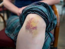Check spelling or type a new query. How To Get Rid Of A Hickey 10 Ways