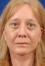 Different Planes Of A Facelift Edina Mn Facelift Cosmetic Surgery Facial Rejuvenation