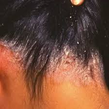 Here are some henna for dandruff treatment packs that will clear it out for good! Female Scalp Peeling Therapy For Dandruff Treatment Id 19126555548