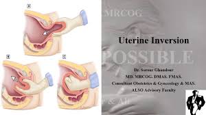 Image result for Uterine Inversion