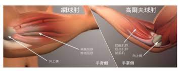 Jun 23, 2021 · 【健康醫療網／記者曾正豪報導】肘關節內上髁骨折是常見的肘部撕脫骨折，像是在平地跌倒、投擲等運動損傷都可能埋下危險因子。亞洲大學附屬. é«˜çˆ¾å¤«é‹å‹•çš„æ‰‹è‚˜å‚·å®³ Nihao ä½ å¥½å‚³åª'