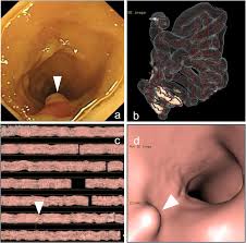 Image result for Virtual Endoscopy