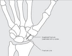 Image result for Scaphoid Bone