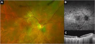 Secondary vitreoretinal lymphoma with spontaneous regression