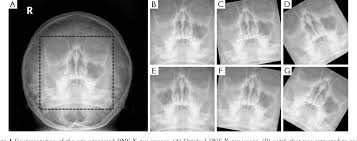 Image result for Sinus X Ray
