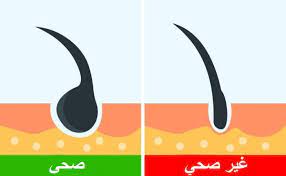 علاج تلف بصيلات الشعر