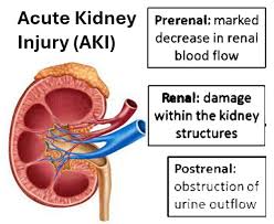 Image result for Postrenal Failure