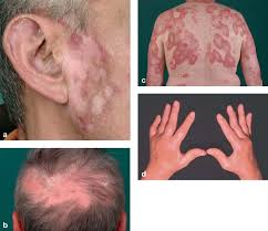 ¿cómo se diagnostica el lupus? The Diagnosis And Treatment Of Systemic Lupus Erythematosus Abstract Europe Pmc