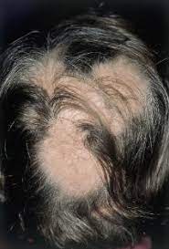 Alopecia areata is a common autoimmune skin disease, causing hair loss on the scalp, face and sometimes on other areas of the body. Alopecia Areata Hauterkrankungen Msd Manual Ausgabe Fur Patienten