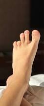 Image result for toe amputation