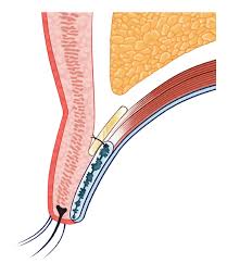 Gold weight & eyelid springs. Acfs Archives Of Craniofacial Surgery