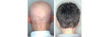 Alopecia areata is a condition which causes hair to fall out in small patches; Arztinformationen Hair Nail
