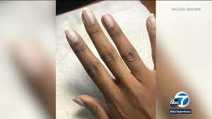 Most skin cancers fall into one of three categories: Skin Cancer Scare Abc7 Anchor Rachel Brown Shared Her Story After Developing Possible Sign Of Subungual Melanoma Abc7 Los Angeles