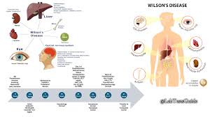 Image result for Wilson Test